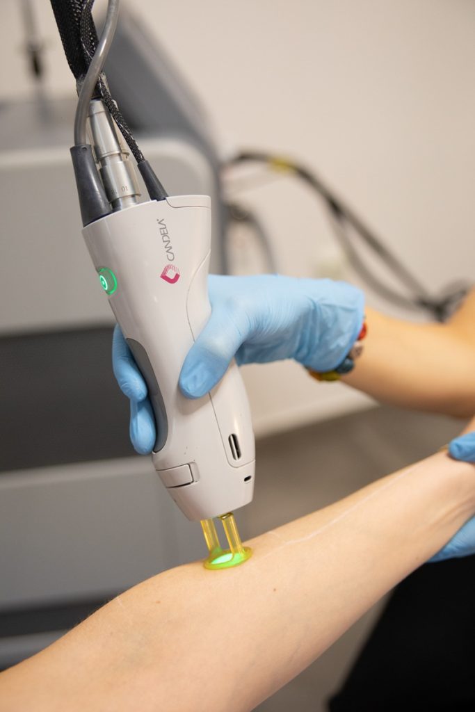 αποτρίχωση laser καλλιθέα 1